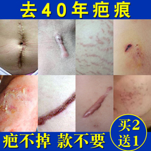 去除妊娠疤修复膏祛手术凹凸疤痕痘坑伤疤去色素 草本疤痕灵正品