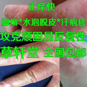 【止痒膏皮肤瘙痒图片】止痒膏皮肤瘙痒图片大