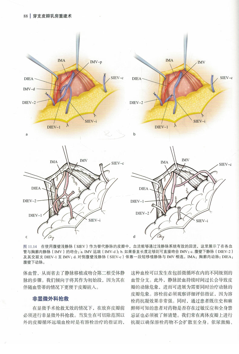 穿支皮瓣乳房重建术