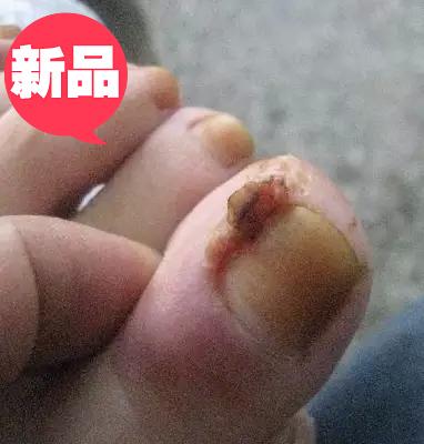 指头生蛇 头疮 脚指头生 蛇头 疮 生蜈蚣 肚 莲藕 节