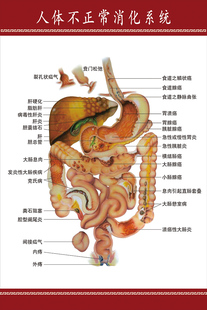 内脏分部图人体解剖图医院宣传挂图 人体不正常的消化系统示意图