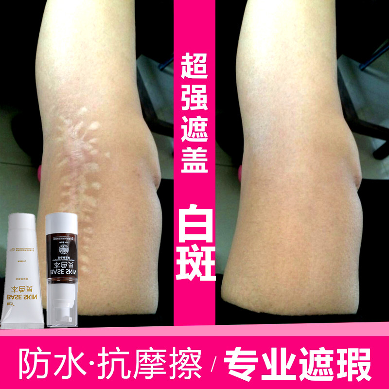 疤痕疙瘩\/烧伤烫伤\/凹疤痘坑\/增生性凸疤\/色素沉