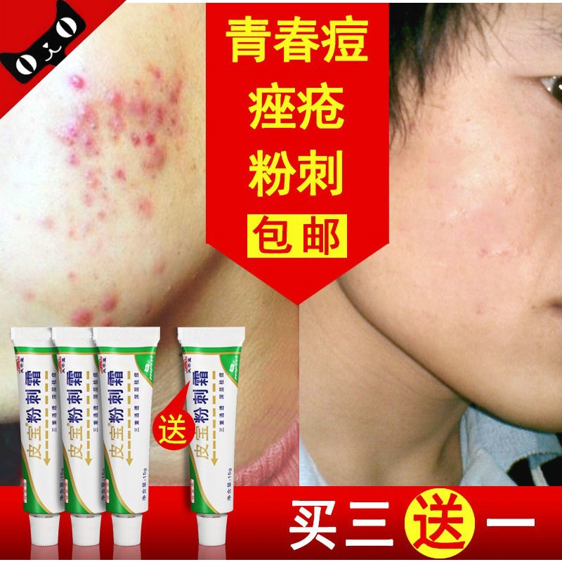 太安堂皮宝粉刺霜祛痘膏暗疮青春痘闭合型粉刺酒糟鼻红镇平包邮