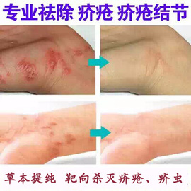 [霜疥疮otc]评价 疥疮图片怎么样