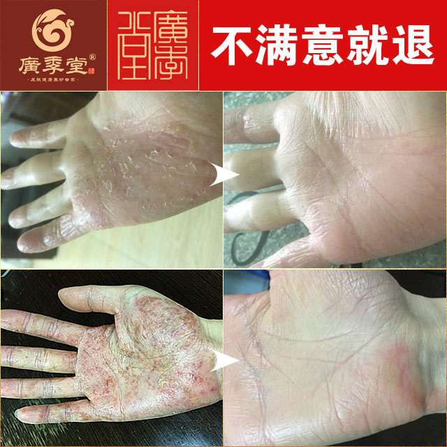 去汗疱疹油小水泡手足脚脱皮止痒膏汗疱宁儿童成人无激素特效去除