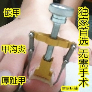 手指 嵌甲矫正器 嵌甲甲沟炎卷甲手指嵌甲脚沟炎矫正脚指甲包邮 正甲
