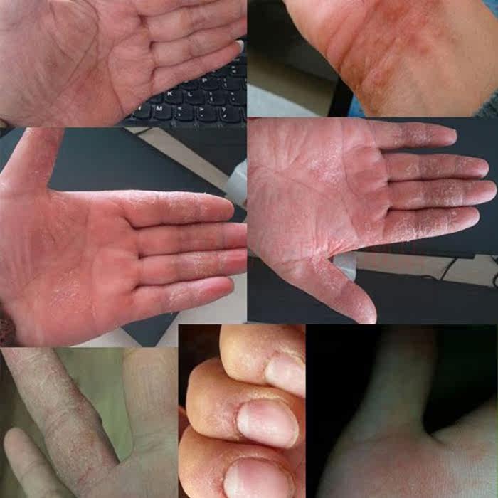 季节性手足脱皮手气水泡脚跟干裂龟裂脚后跟皲裂修复霜开裂防裂膏