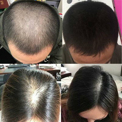 育发液头发增长液快速变长生发液脂溢性止脱防脱发液短发6倍增长