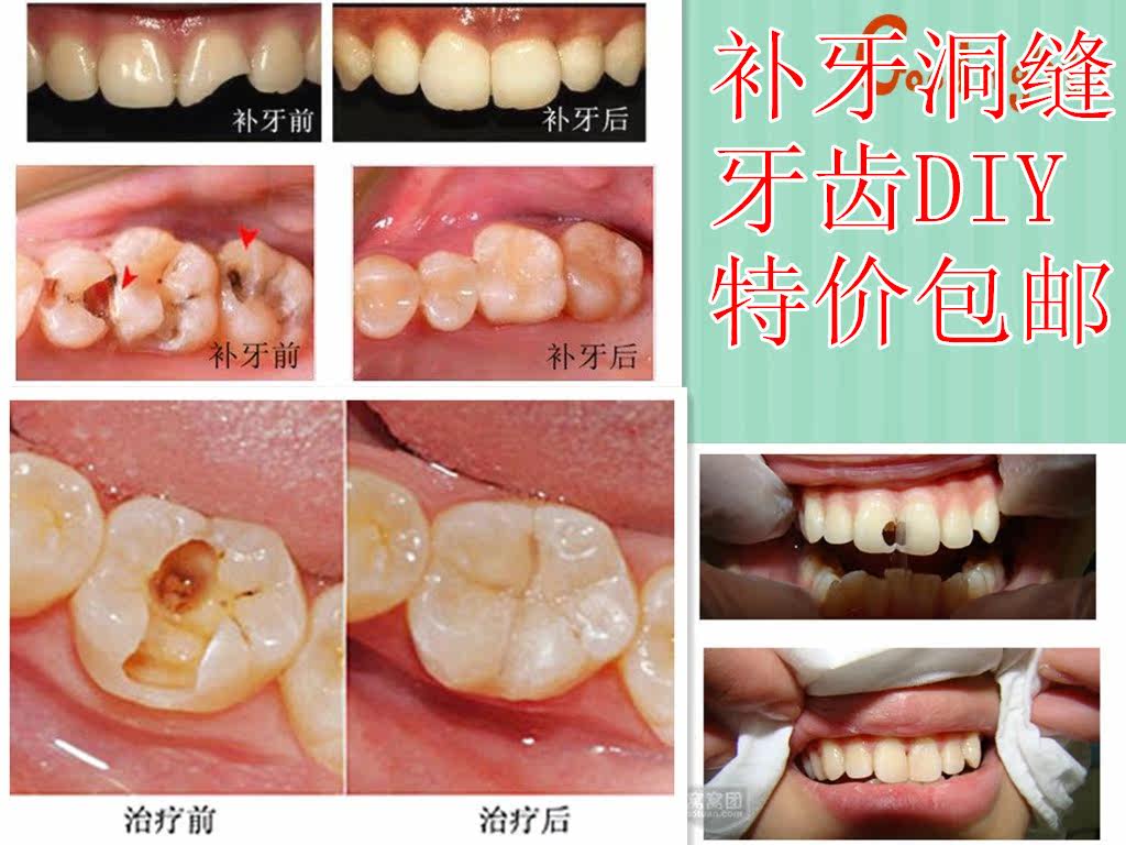 补牙缝的图片,树脂补牙缝图片,门牙牙缝填充图片_大山谷图库