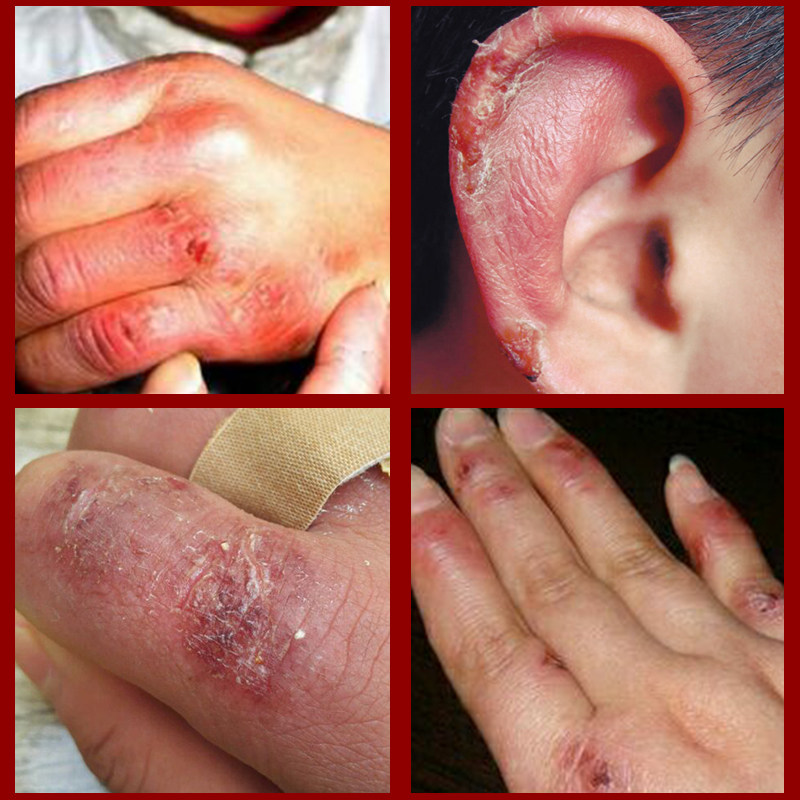 冻疮膏特效止痒 防干裂防冻霜润手霜修复保湿护手防冻伤膏