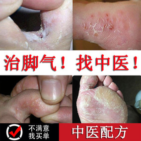 治腳氣噴劑止癢脫皮水泡型泡腳特效去除腳臭腳癢腳氣王藥膏足光粉